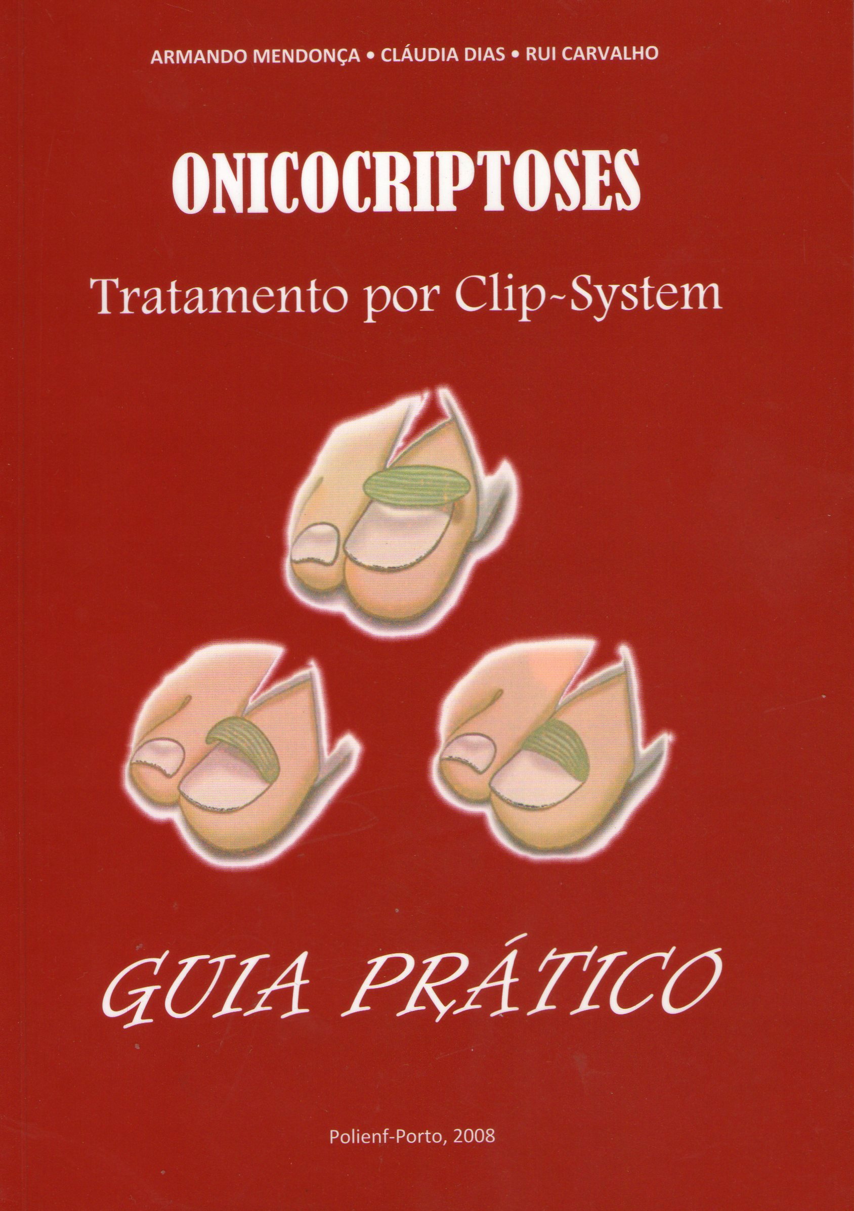 Onicocriptoses: Tratamento por Clip-System - Guia Prático