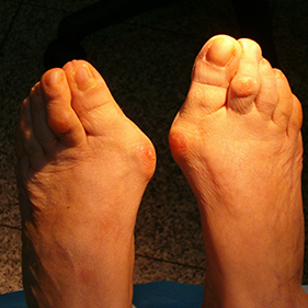 Deformidades dos dedos: Hallux Valgus – joanetes